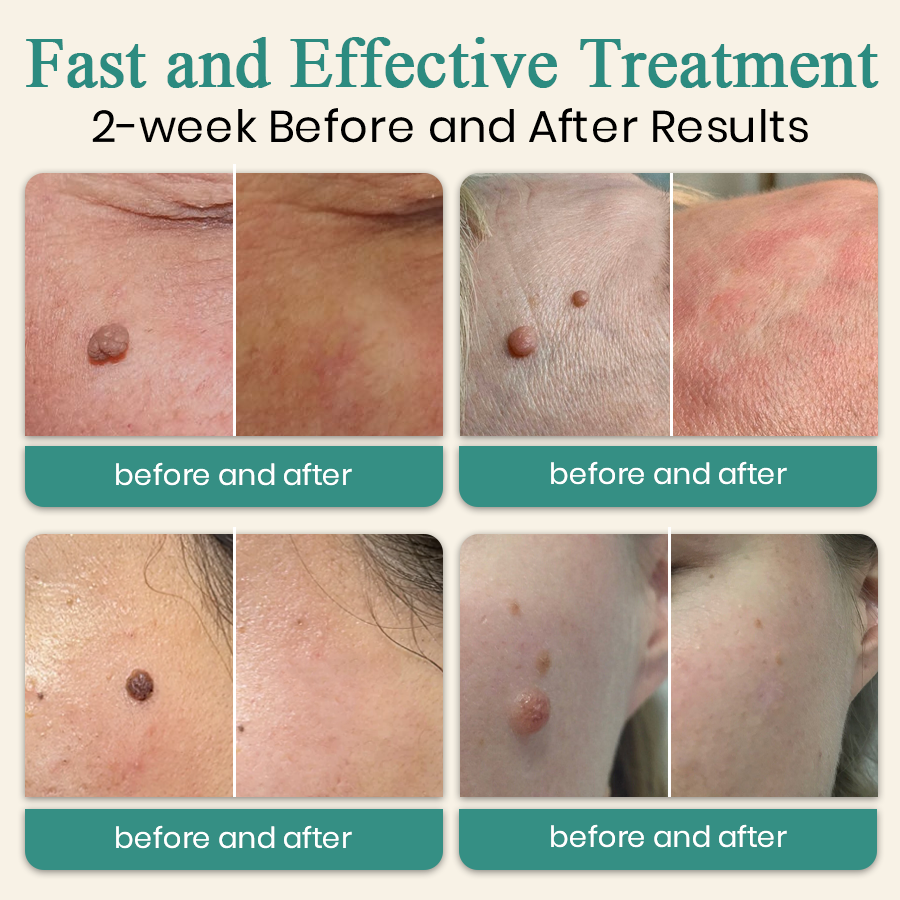 DAFEILA® LumeSkin Mole and Wart Instant Removal Laser Pen 7