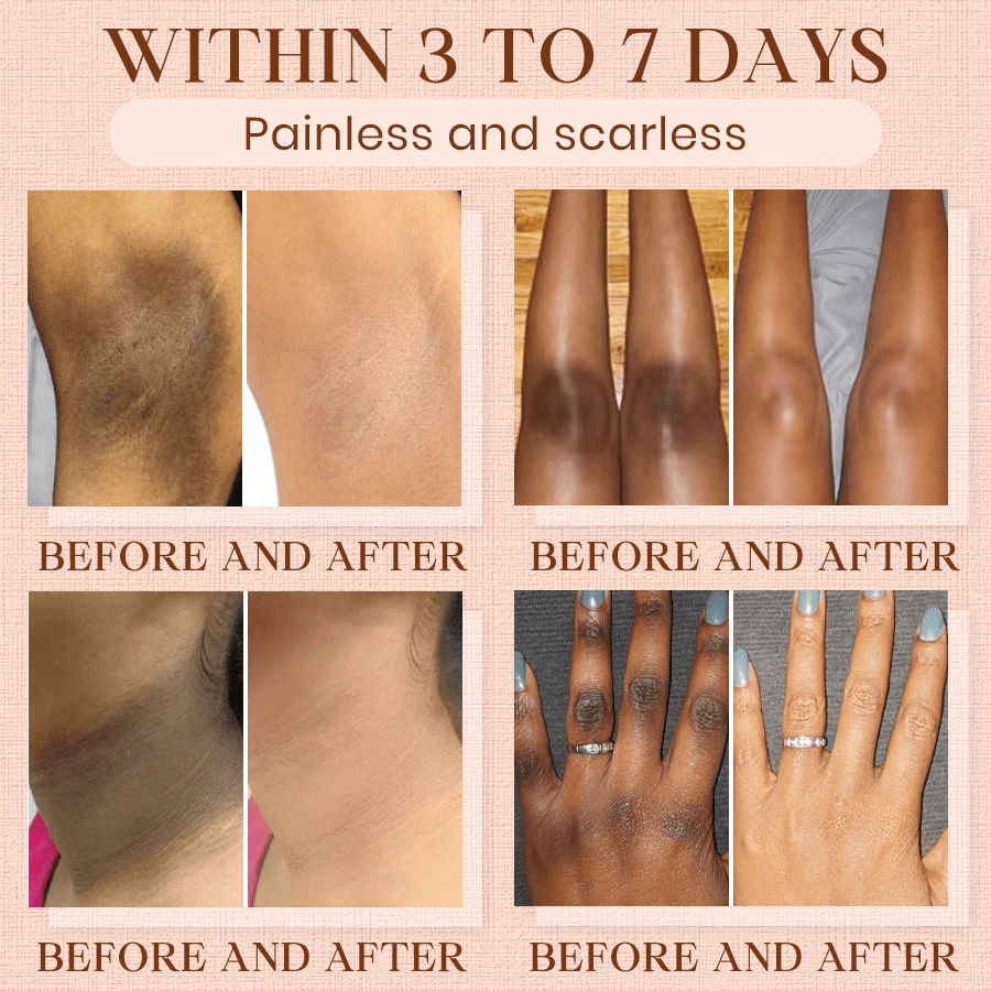 Luhaka® Purifying Exfoliating Gel for Acanthosis Nigricans, Exfoliation, Dark Spots, Skin Tags, and Eczema 🎁