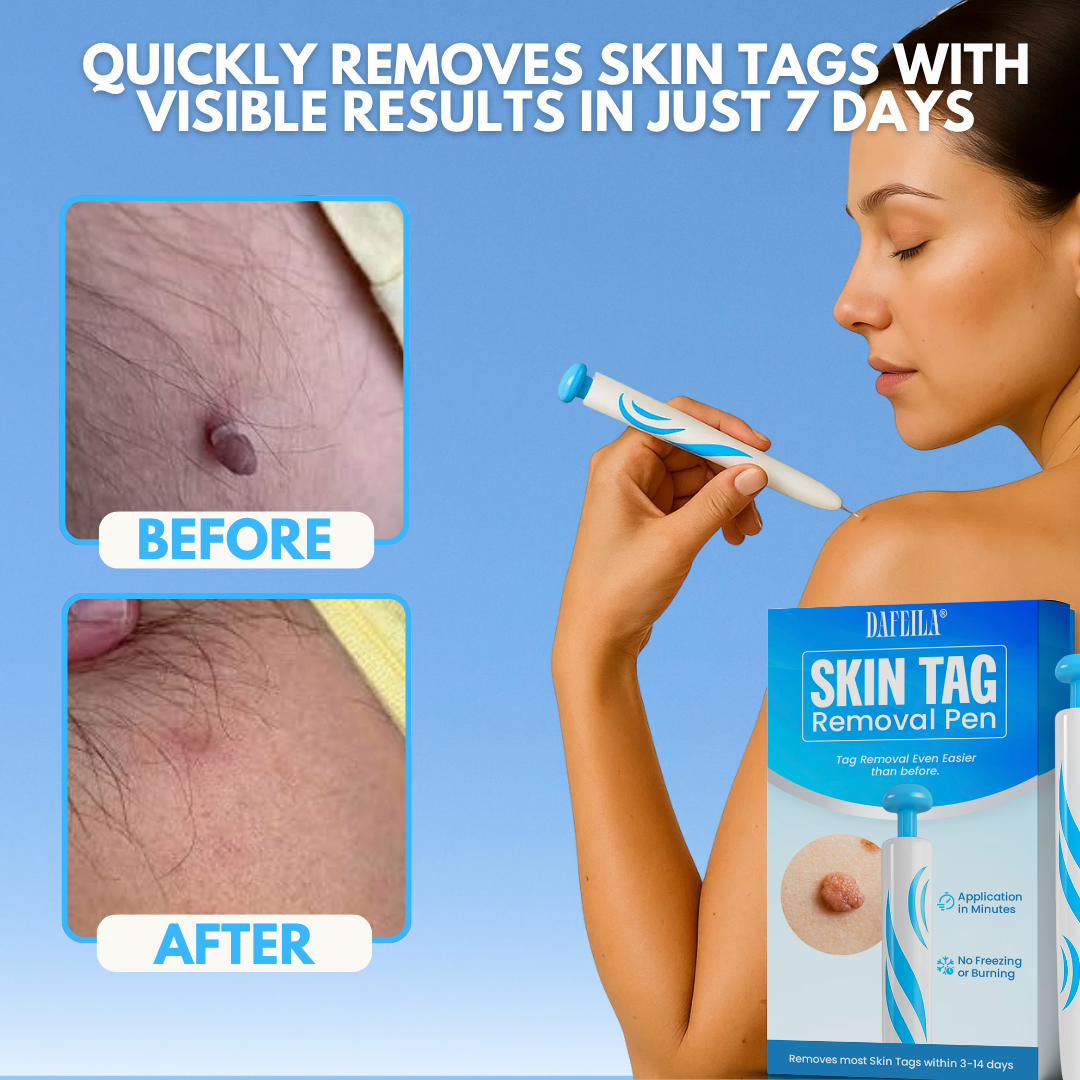 Dafeila® Skin Tag Removal Pen ACE 1