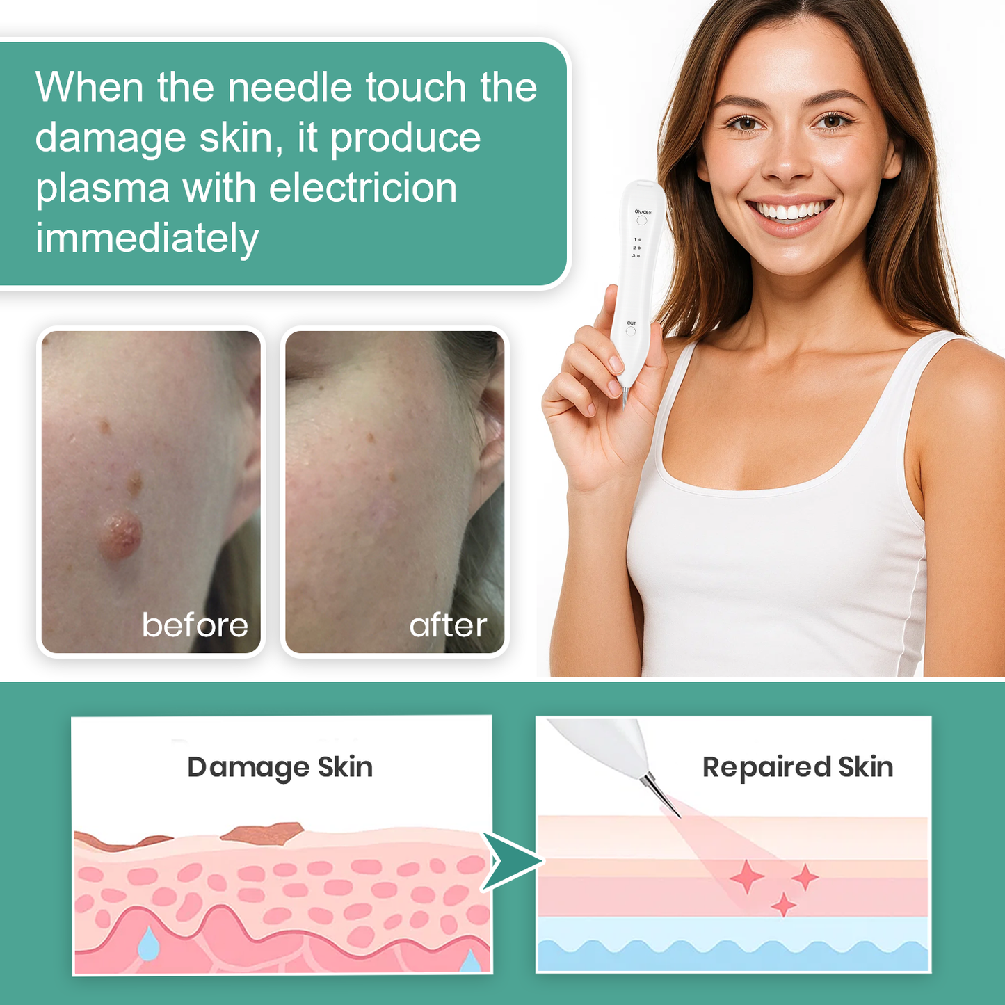 Dafeila® Advanced Plasma Laser Spot Cleaning Pen 🎉