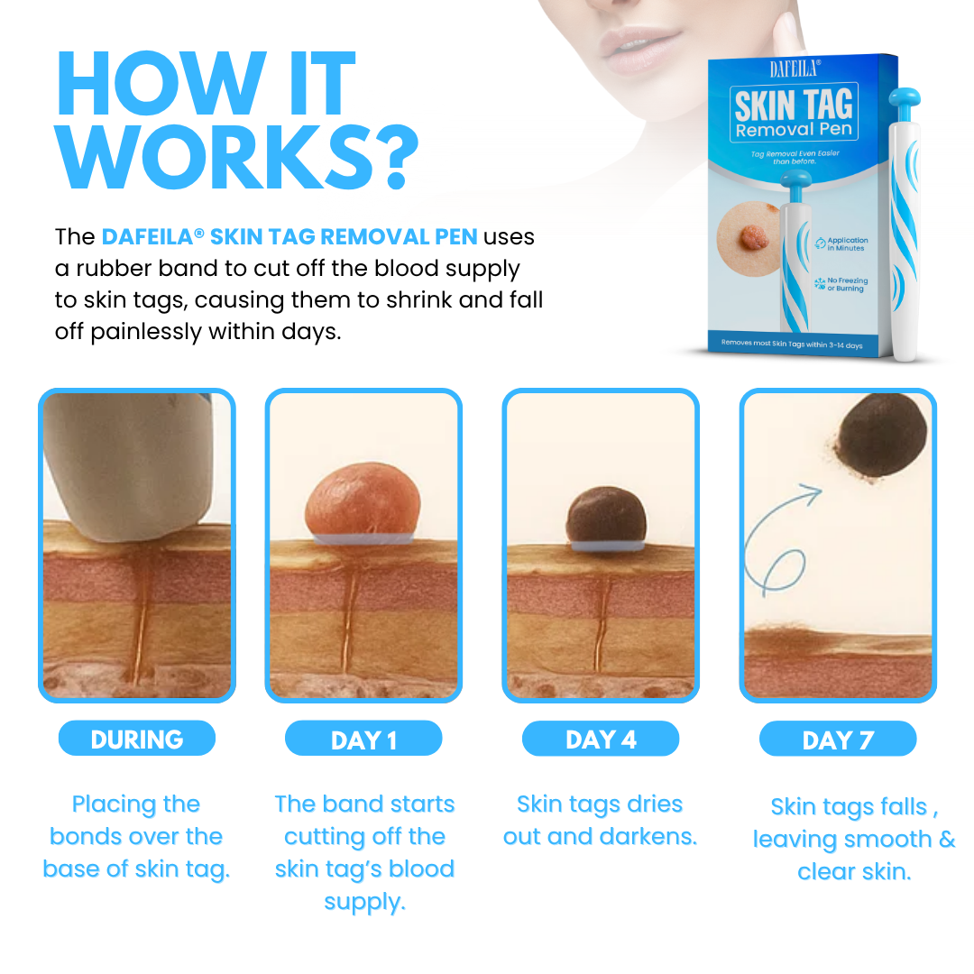 Dafeila® Skin Tag Removal Pen ACE 1
