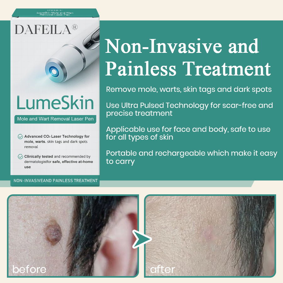 DAFEILA® LumeSkin Mole and Wart Instant Removal Laser Pen 7