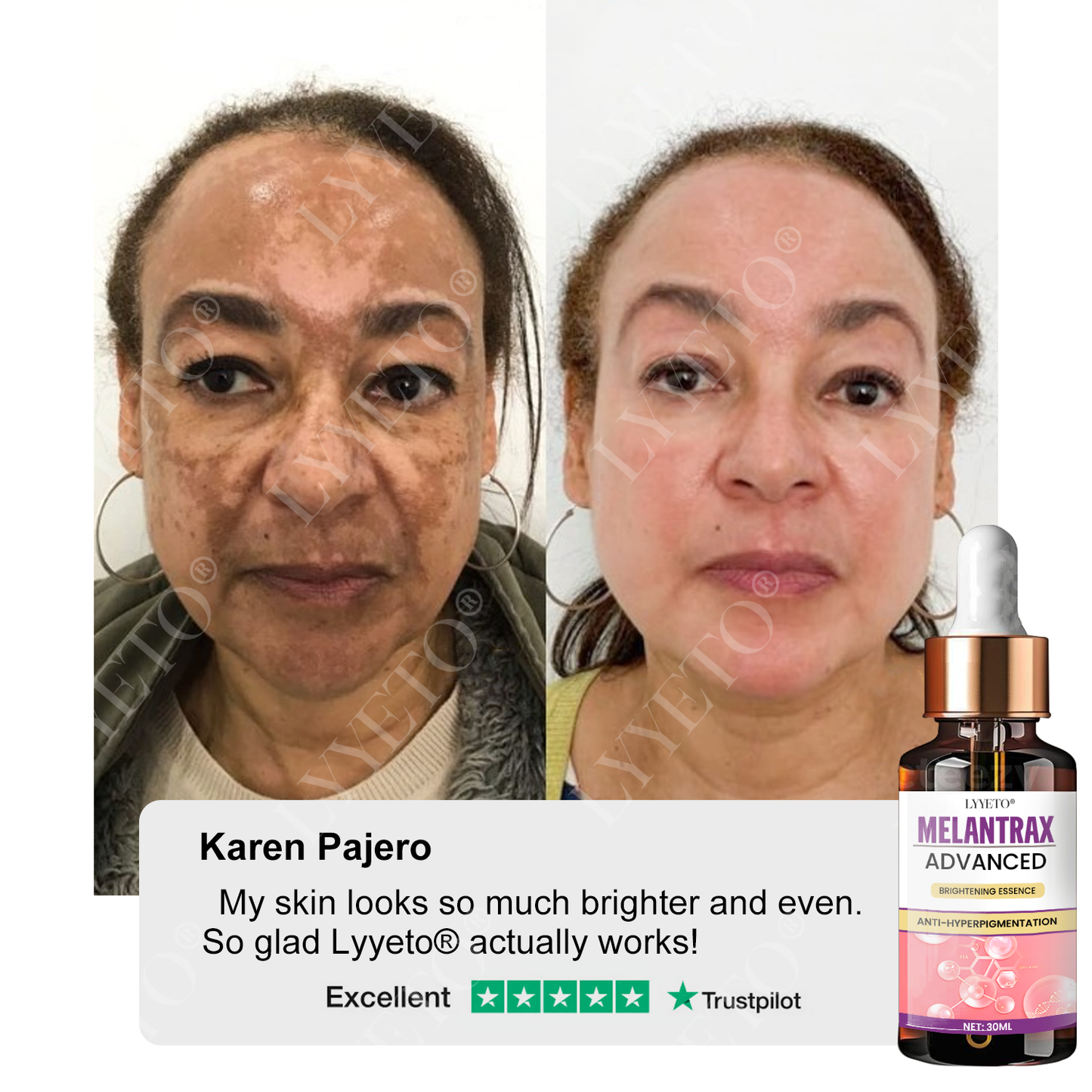 Lyyeto® MelantraX Advanced Brightening Essence