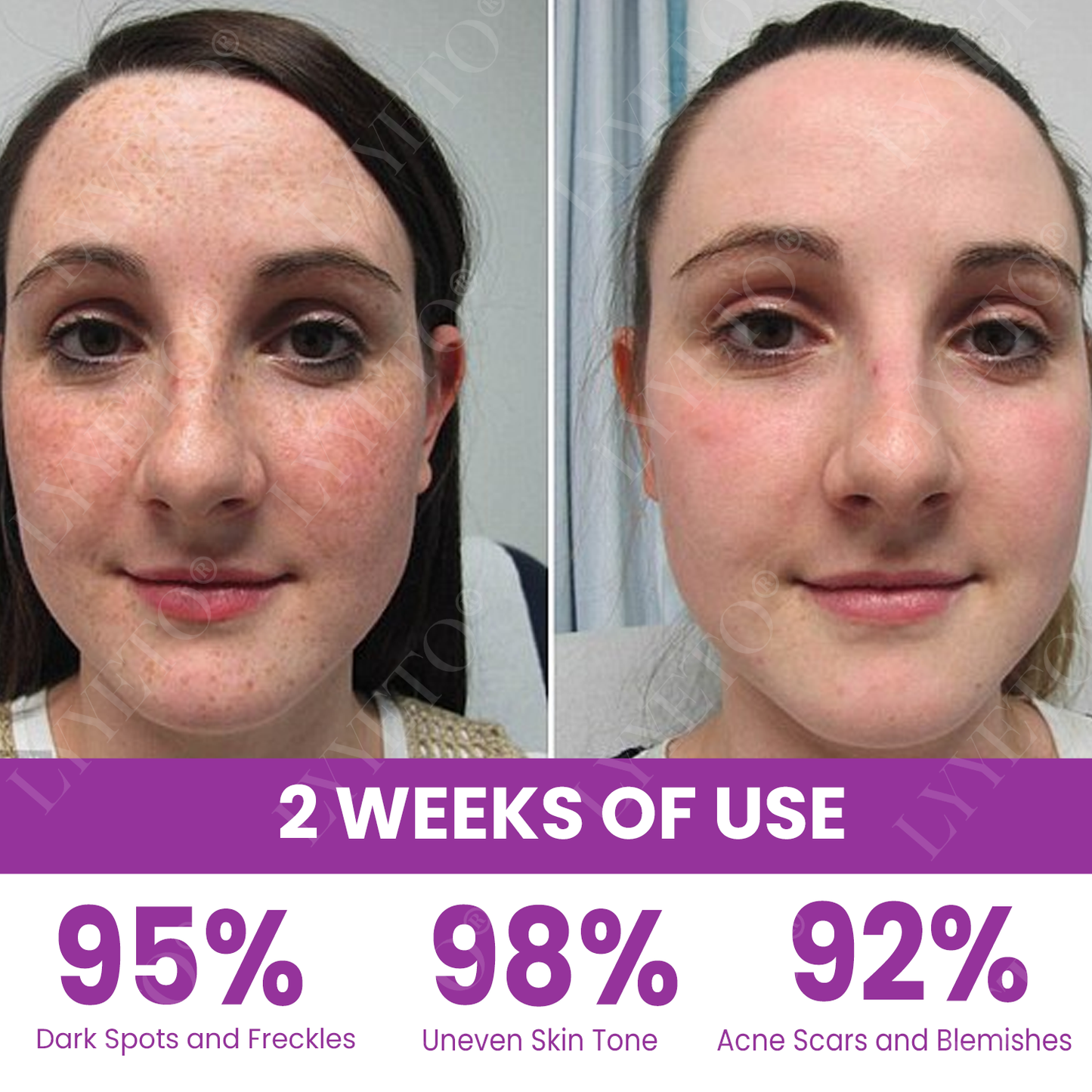 Lyyeto® MelantraX Advanced Brightening Essence