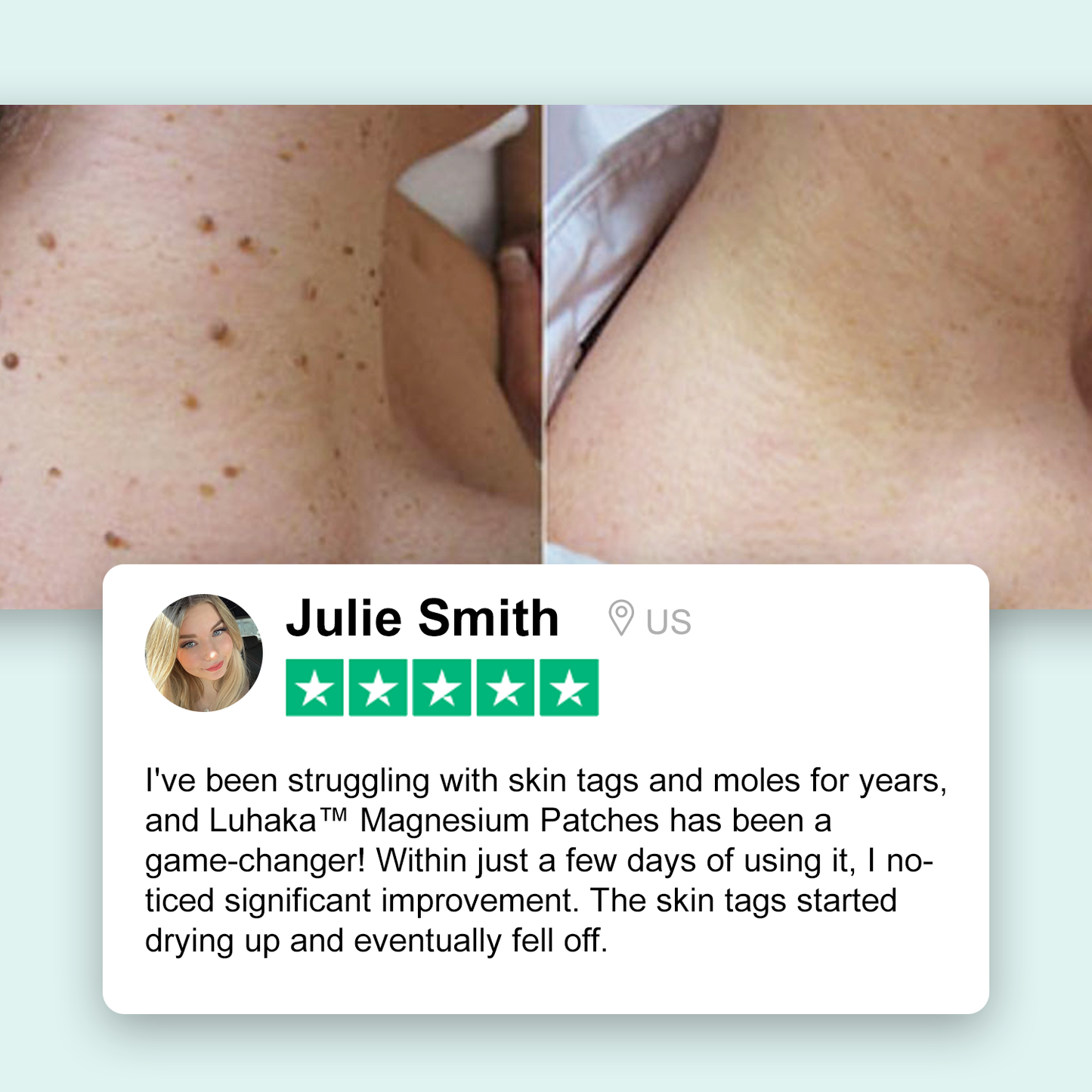 Luhaka® Magnesium Micro-pin Wart Removal Patch_Ultra03