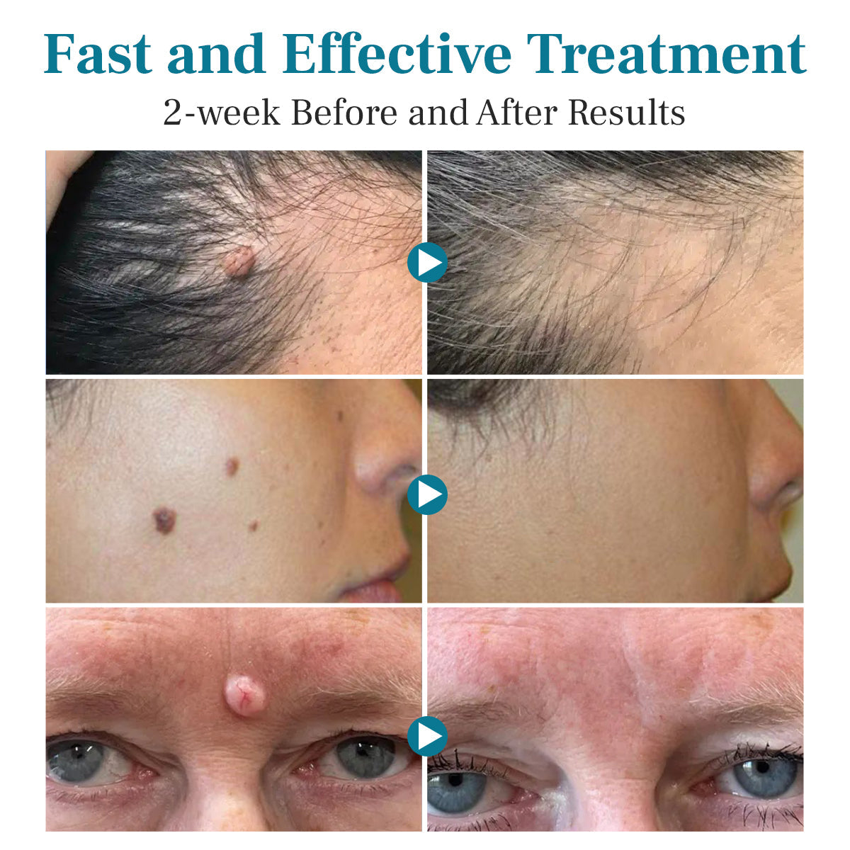 DAFEILA® LumeSkin Mole and Wart Removal Laser Pen 5