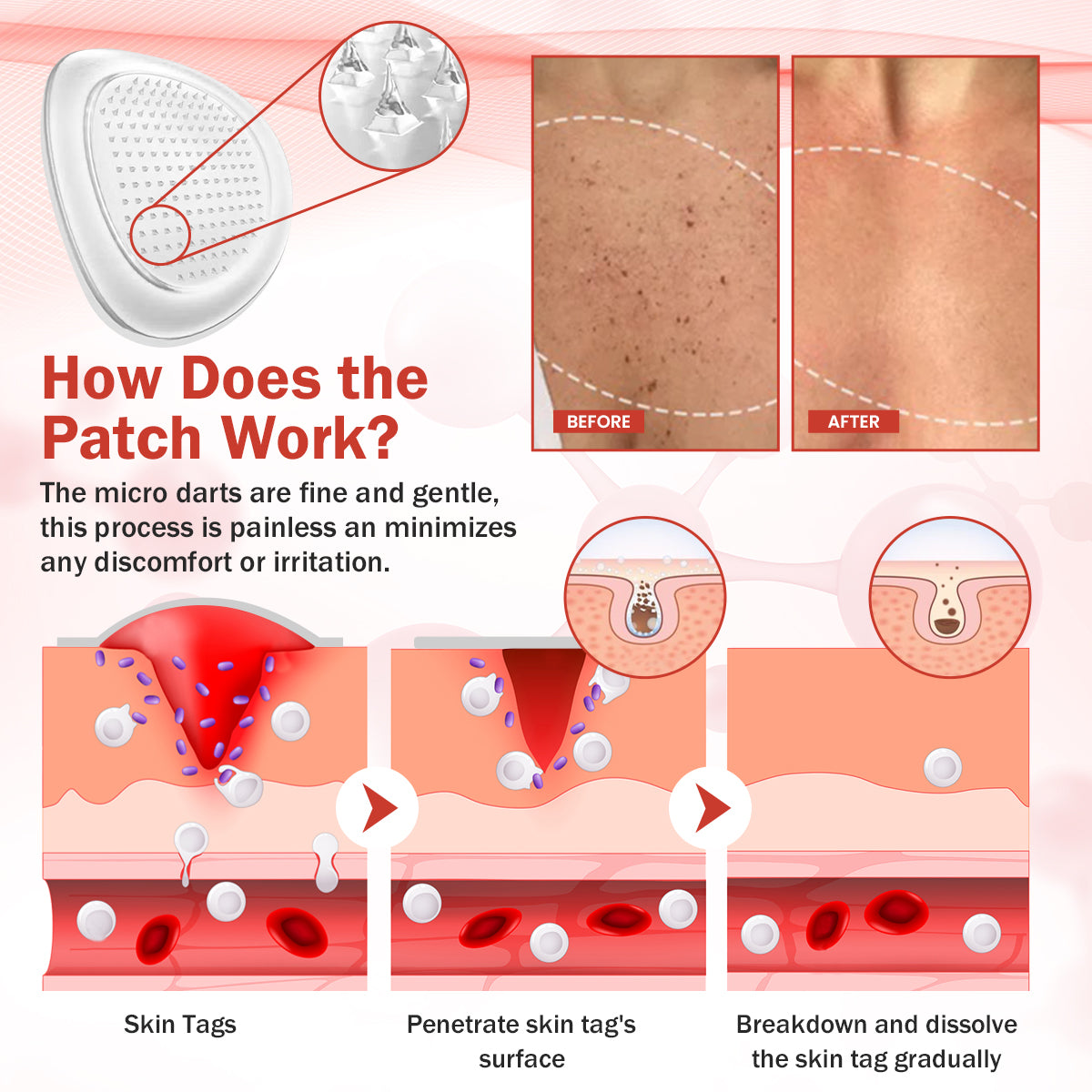 Luhaka® PureSkin Microneedle Botanic Skin Tag Removal Patch
