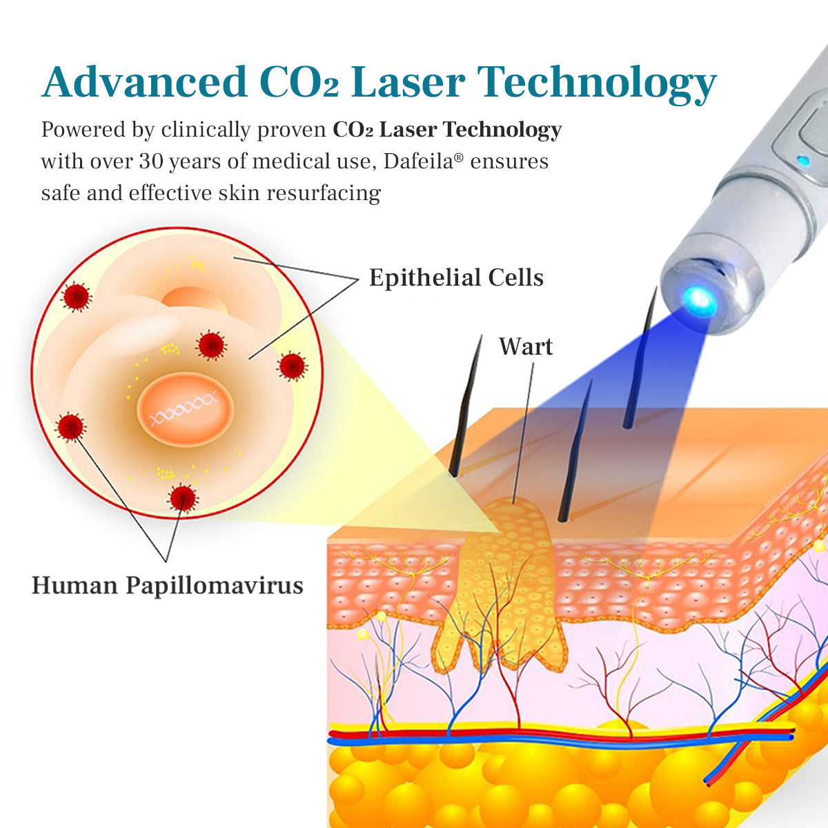 DAFEILA® LumeSkin Mole and Wart Removal Laser Pen 5