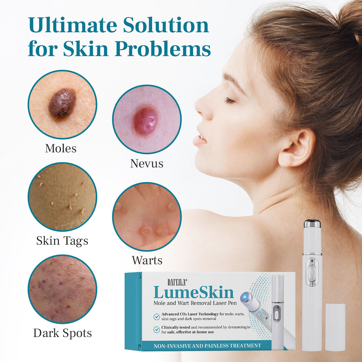 DAFEILA® LumeSkin Mole and Wart Removal Laser Pen 5