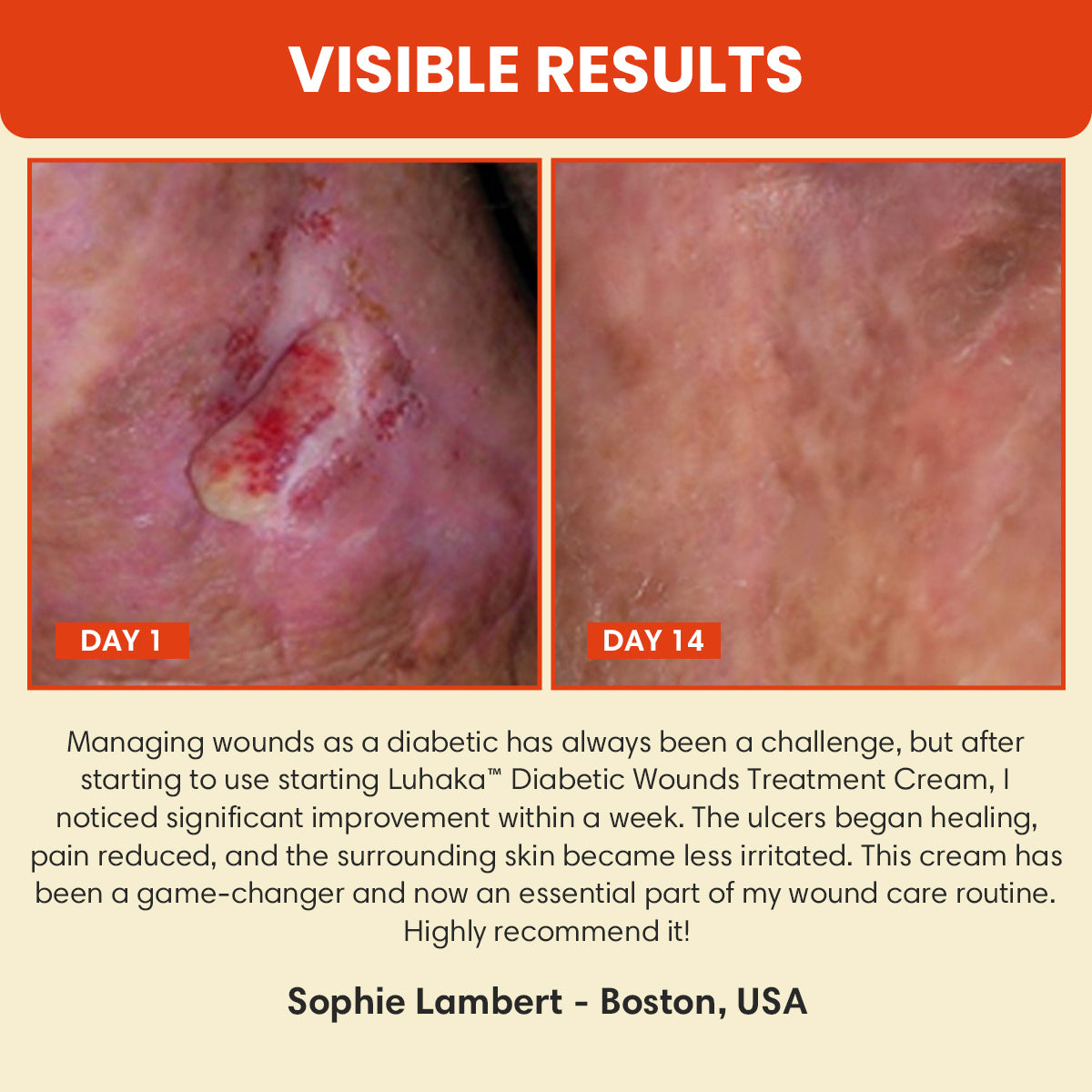 Luhaka™ Diabetic Wounds Treatment Cream_Ultra02