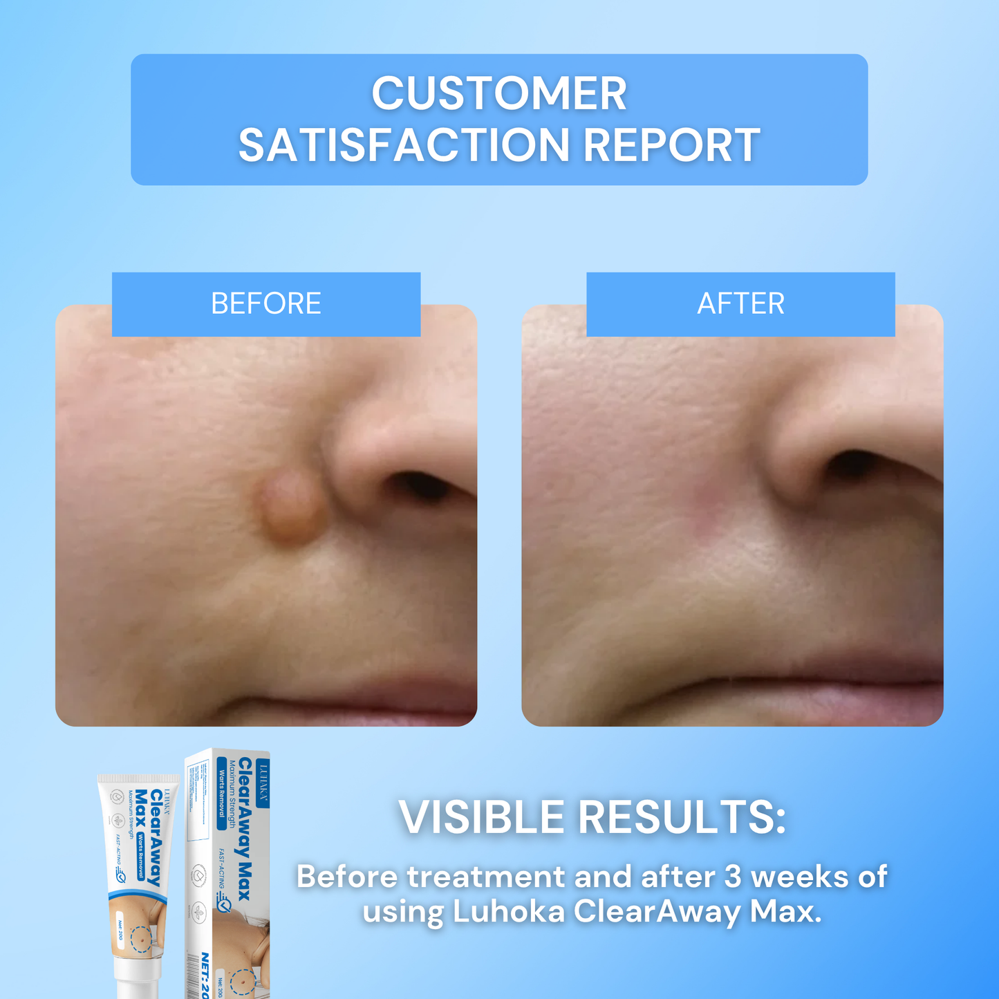 Luhaka® Clear Away Wax Warts Removal ACE 3