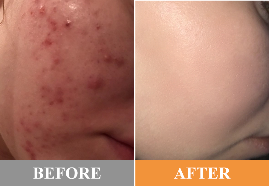 Luhaka® Exfoliating Gel ACE 6 image Luhaka® Exfoliating Gel ACE 6