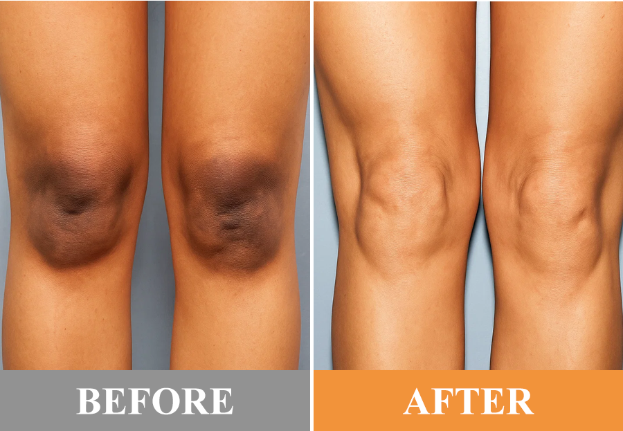 Luhaka® Exfoliating Gel ACE 6 image Luhaka® Exfoliating Gel ACE 6