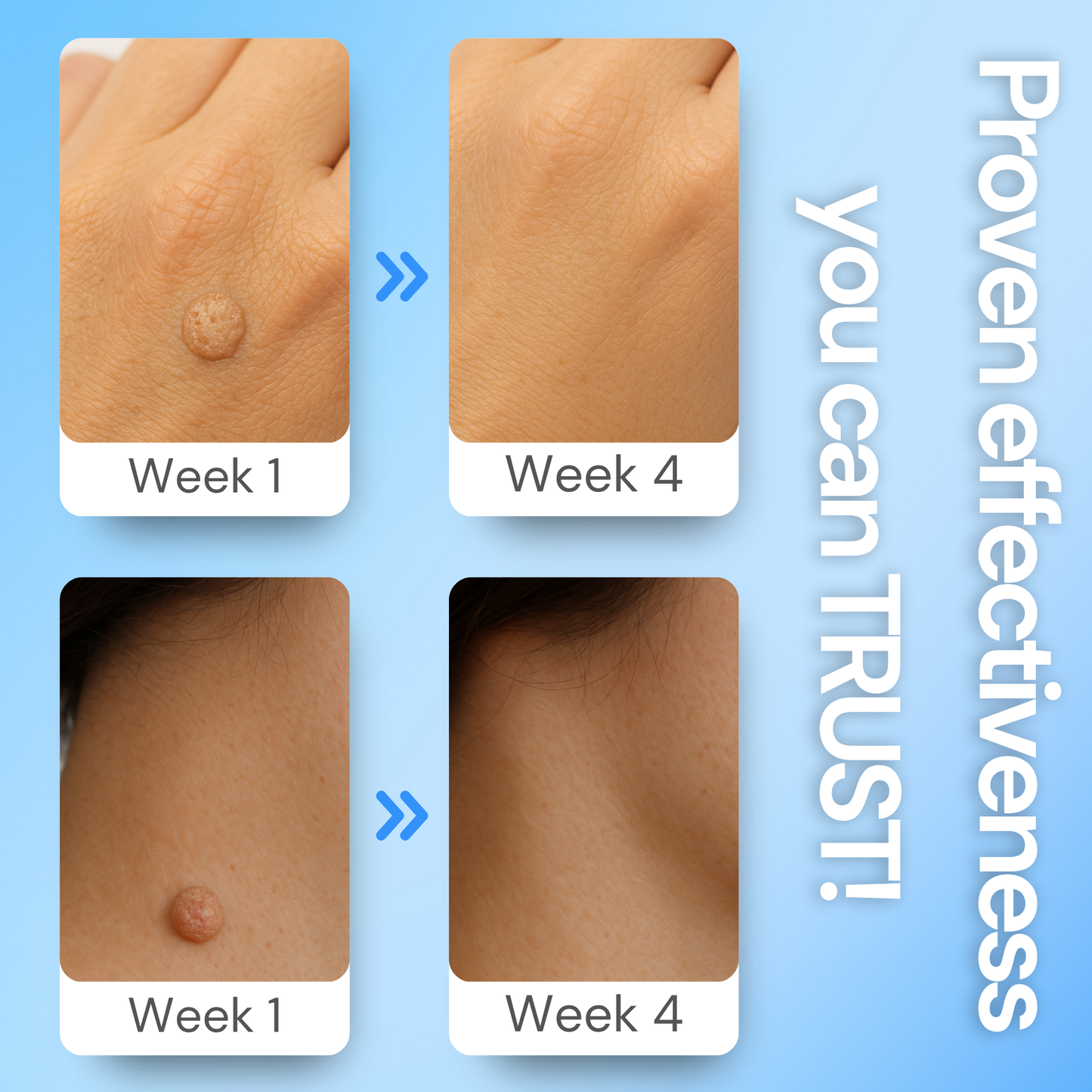 Luhaka® Clear Away Wax Warts Removal ACE 3
