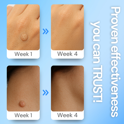 Luhaka® Clear Away Wax Warts Removal ACE 3