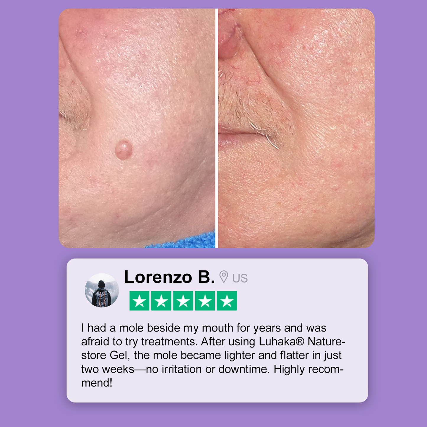 Luhaka® Naturestore Wart and Mole Removal Gel 🌟