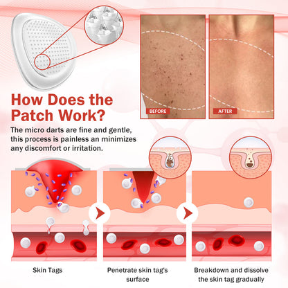 Luhaka® PureSkin Microneedle Botanic Skin Tag Removal Patch ACE 1