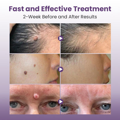 GORT Mole & Skin Tag Removal Pen