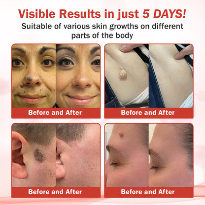 Luhaka® PureSkin Microneedle Botanic Skin Tag Removal Patch ACE 1