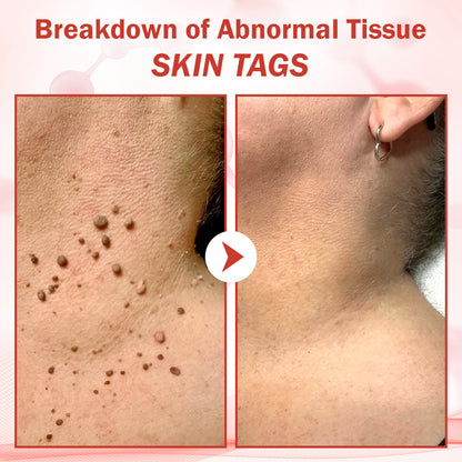 Luhaka® PureSkin Microneedle Botanic Skin Tag Removal Patch ACE 1